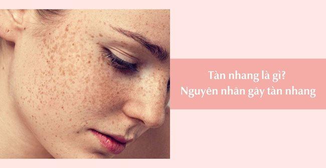 8 Cách trị tàn nhang tận gốc, an toàn, hiệu quả