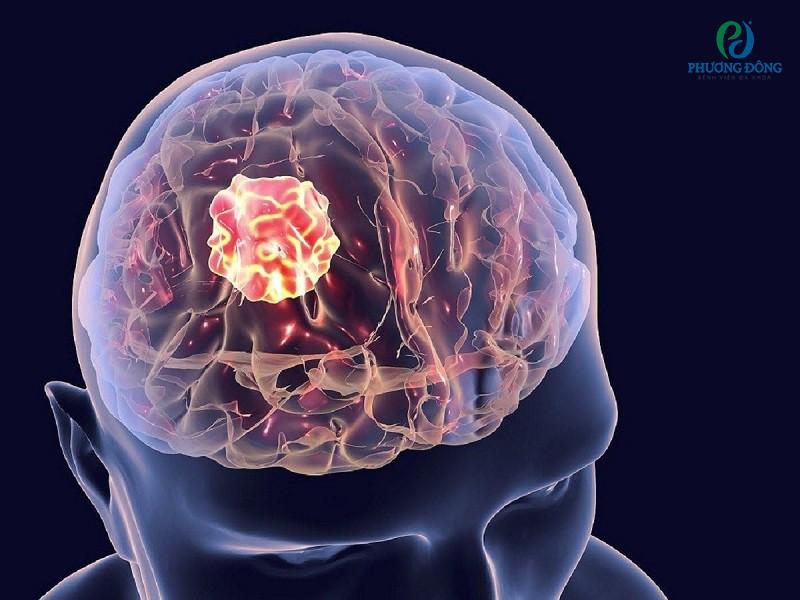 Bệnh u não và những thông tin quan trọng cần biết